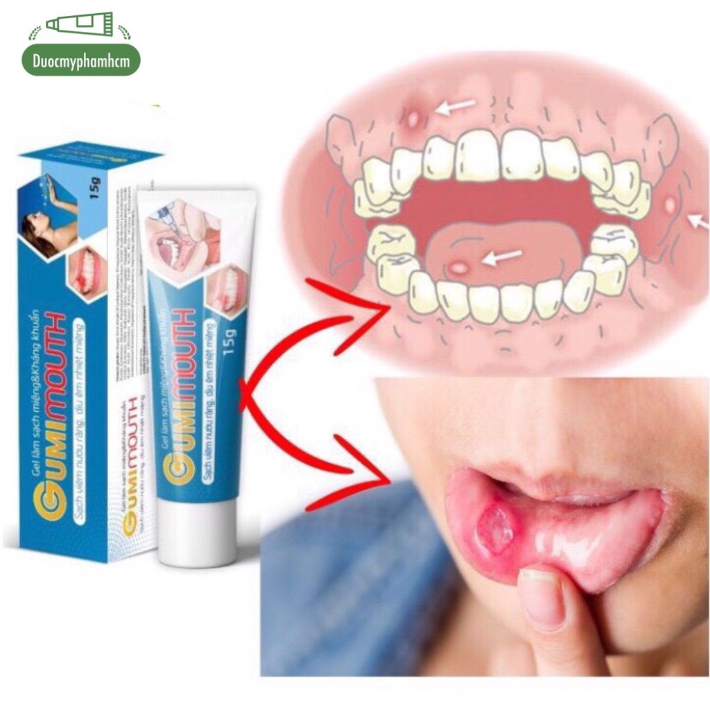 Gel Gumimouth - Sạch Viêm Nướu Răng &amp; Dịu Êm Nhiệt Miệng Tuyp 15g