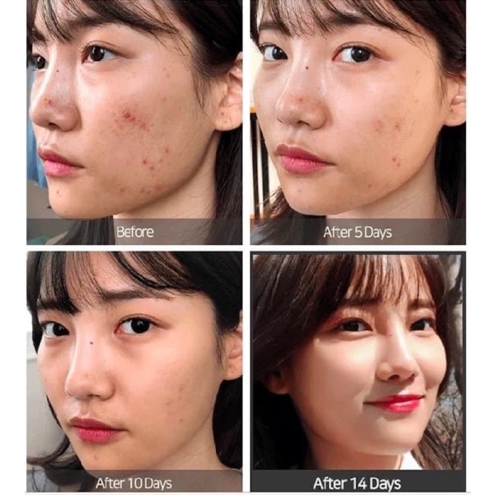 Serum tri mụn Some By Mi AHA-BHA-PHA 30 Days Miracle