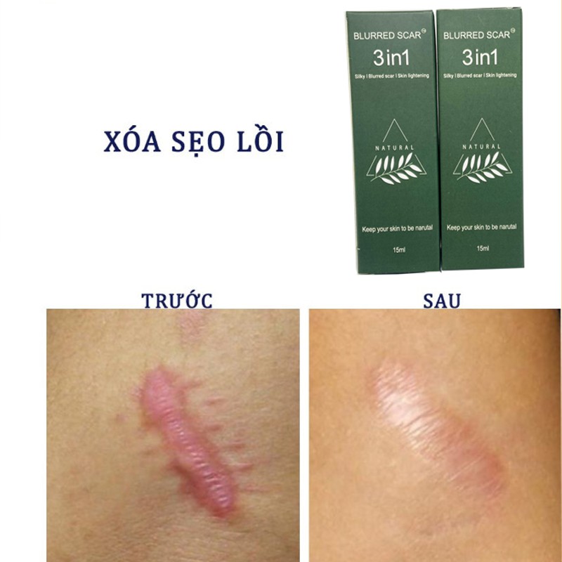 Serum Sẹo Lồi Lõm và Rỗ Lâu Năm BLURRED SCAR | BigBuy360 - bigbuy360.vn