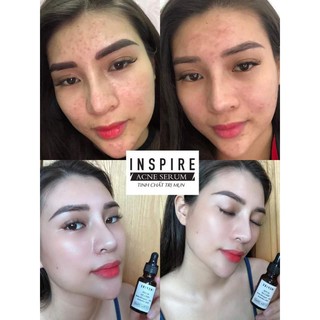 Tinh chất mụn INSPIRE ACEN