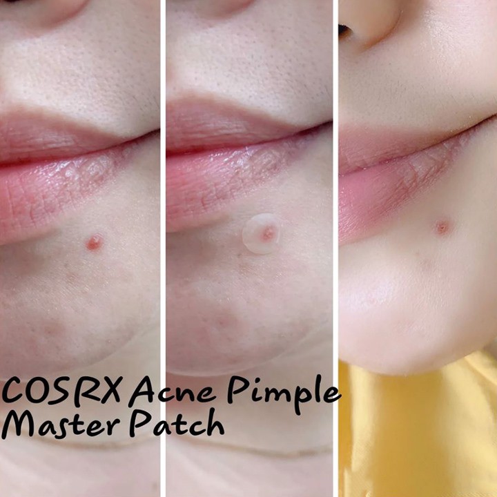 Miếng dán hút còi mụn COSRX Acne Pimple Master Patch