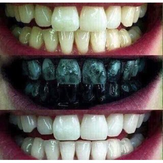 Kem đánh răng than hoạt tính GLORY SMILE trắng răng sau 1 tuần sử dụng