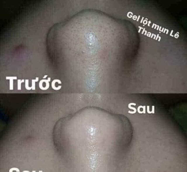 Gel hút mụn than tre hoạt tính