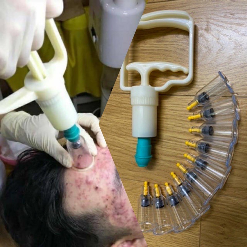Bộ giác hơi bé hút mụn viêm, máu bầm