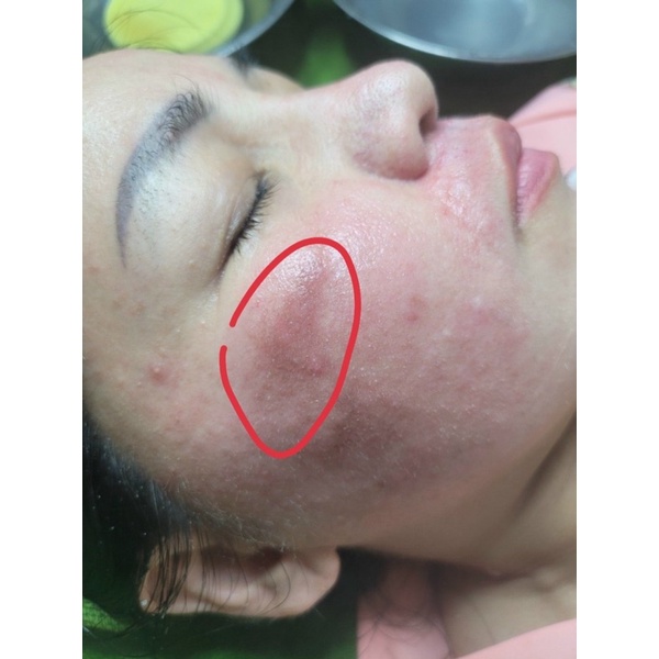 Serum p,h,ụ,c h,ồi sau đi,ề,u tr,,ị nám, mụn