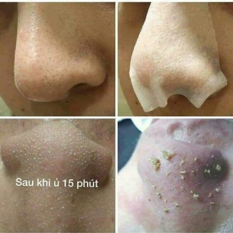 DUNG DỊCH Ủ MỤN ĐẦU ĐEN CHUYÊN DÙNG SPA