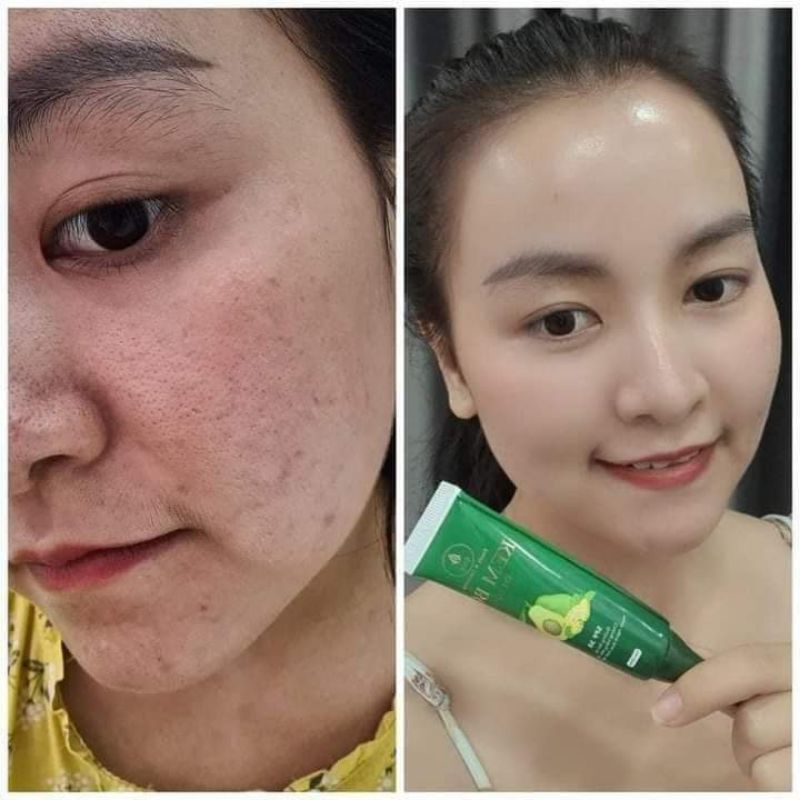 COMBO 5 KEM BƠ NANO OLIC + TẶNG BODY BIA + SỮA RỬA MẶT