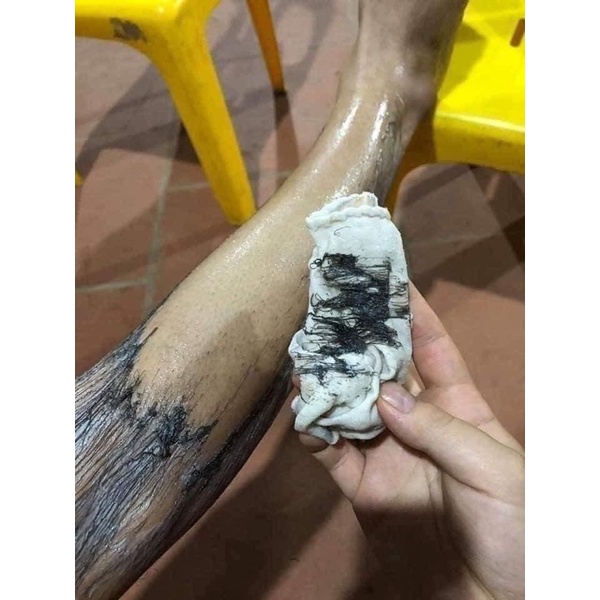 TRIỆT LÔNG NANO GEL