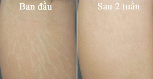 KEM TRỊ RẠN DA BÁN CHẠY SỐ 1 TẠI MỸ - REJUVASKIN 60G