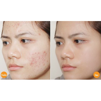 Serum Skin Care N-Collagen 10ml - Loại bỏ mụn nám tàn nhan sẵn