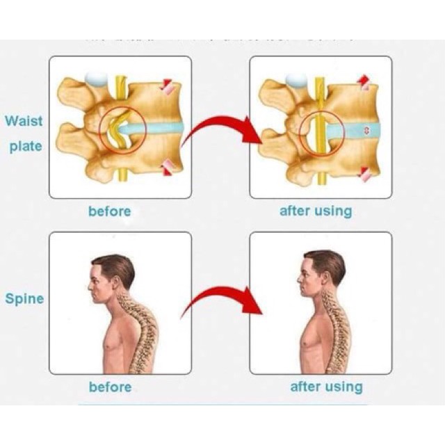 Khung nắn lưng chống thoái hoá cột sống .