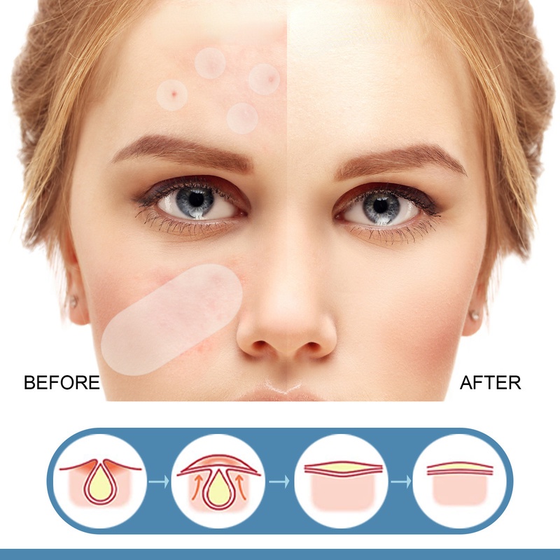 Miếng Dán Hỗ Trợ Giảm Mụn Vô Hình / Nhiều Kích Thước / Chống Thấm Nước Cải Thiện Tình Trạng Mụn Mặt