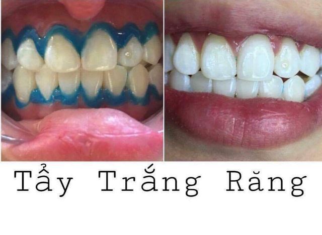 Che nướu tẩy trắng răng