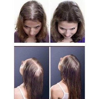 Xịt Kích Mọc Tóc, Giảm Rụng Tóc EKSIDERM