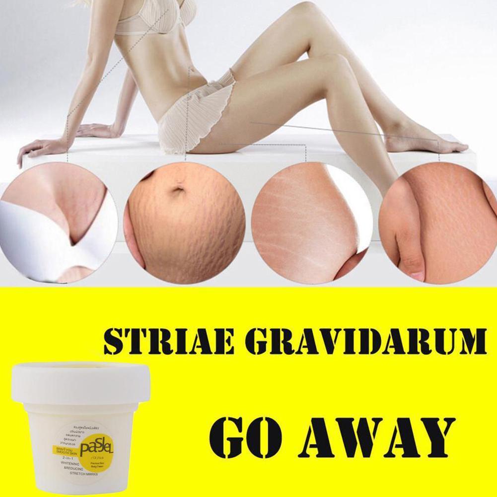 Kem Trị Rạn Da Sau Sinh Cho Phụ Nữ Mang Thai O8E2