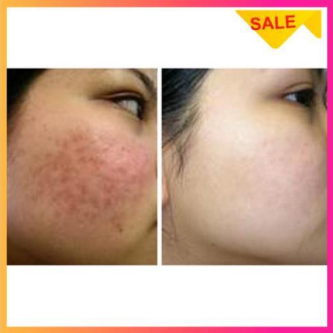 [SIÊU KHYẾN MÃI]Serum Skin 7 Days giảm mụn thâm - chống lão hóa hiệu quả sau 7 ngày | BigBuy360 - bigbuy360.vn