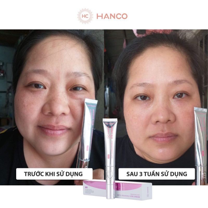 Kem Mắt Hanco - Eye Cream Hanco Kèm Đầu Rung Massage Xóa Thâm- Xóa Nhăn