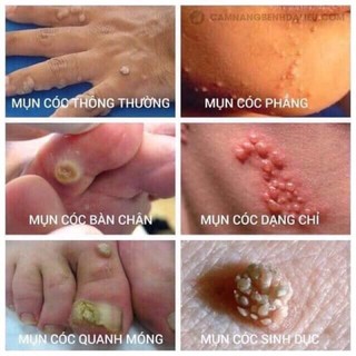 chấm mụn cơm mụn cóc ConCon Thái Lan