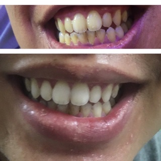 Bộ ngậm trắng răng Brighter White