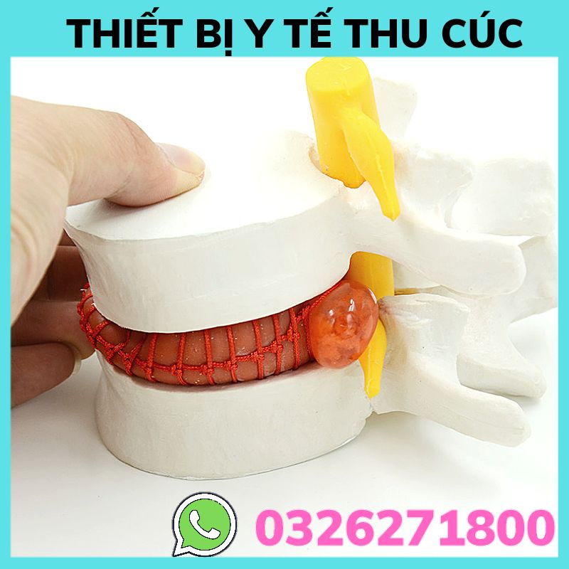Mô hình thoát vị cột sống