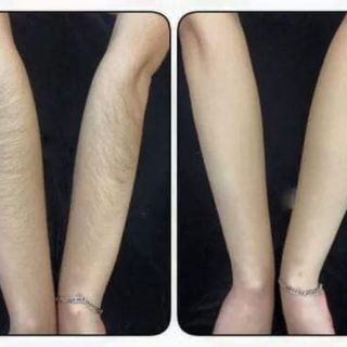 [SIÊU KHUYẾN MÃI] COMBO BỘ ĐÔI TRIỆT LÔNG VĨNH VIỄN + 🎁