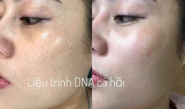 (1 Ống) Tế Bào Gốc Cá Hồi SUPER SKIN SALMON DNA Chính Hãng