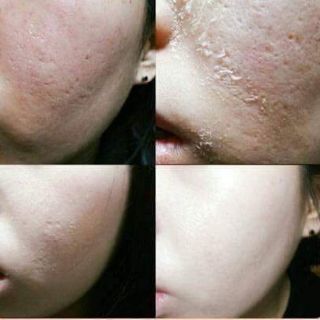 Peel da sinh học B-tox peel