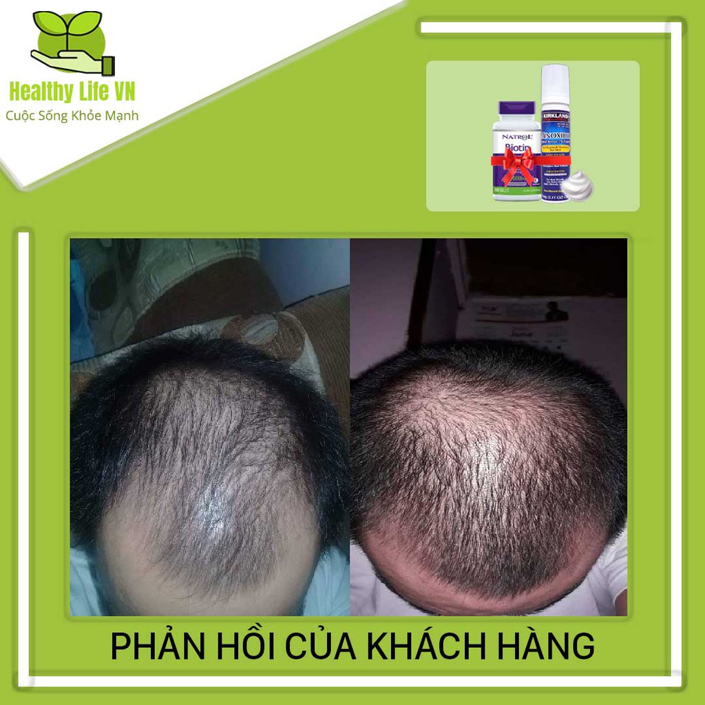 Minoxidil 5% Mọc Râu Dạng Bọt Kirkland Combo Giúp Râu Mọc Nhanh Đen