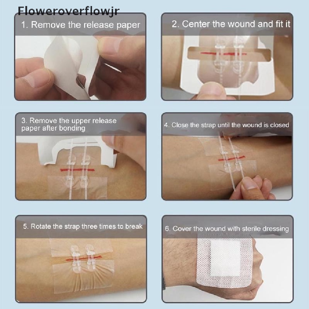 Fojr Miếng Vá Vết Thương Không Đau Không Cần Khoan Có Dây Kéo