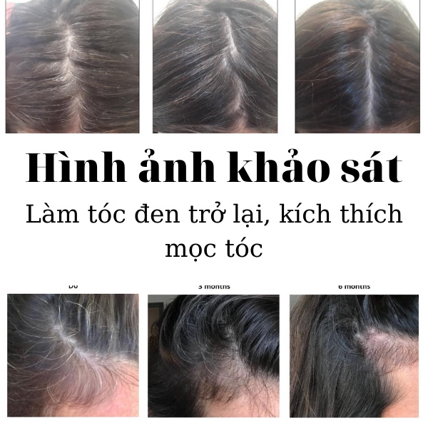 Serum Kích Thích Mọc Tóc, Ngăn Rụng Tóc, Làm Tóc Đen Trở Lại Fobe Hair- Chai 50ml- Đạt chuẩn GMP