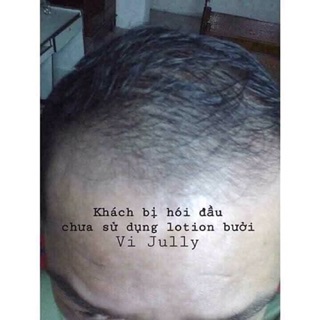 TINH DẦU BƯỞI TRỊ RỤNG TÓC VIJULLY