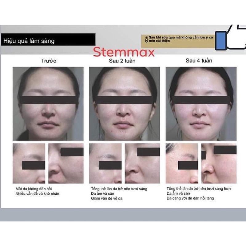 Mặt nạ tế bào gốc PiCos Stemmax 2 Step giảm mụn dưỡng trắng cấp ẩm tái tạo phục hồi da hộp 5 miếng