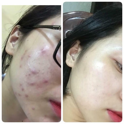 Kem mụn sưng đỏ Acne Cream IRC hết mụn giảm thâm, tái tạo da mới sạch khuẩn, không tái viêm 10g