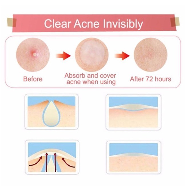 Miếng dán mụn Some By Mi Acnes Clear Patch