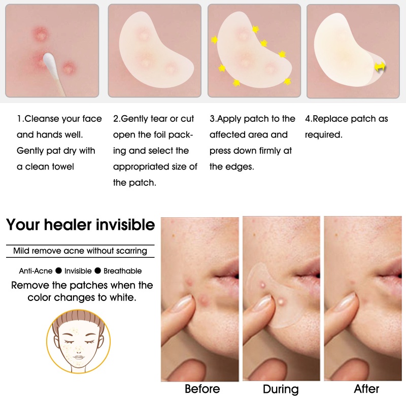 Bộ 20 Miếng Dán Hỗ Trợ Giảm Mụn Hấp Thụ Hydrocolloid Zit S