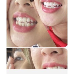 (5 COMBO QUÀ TẶNG TỰ CHỌN) Bộ Kit Làm Trắng Răng Smilee Tẩy Trắng Răng Trong Vòng 7 Ngày Tại Nhà.
