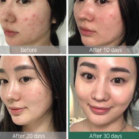 Nước Hoa Hồng Some By Mi AHA-BHA-PHA 30 Days Miracle Toner 150ml Giúp làm sạch bụi bẩn, bã nhờn và da chết trên bề mặt d | BigBuy360 - bigbuy360.vn