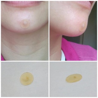 Miếng dán mụn thần thánh 3M Nexcare ❌