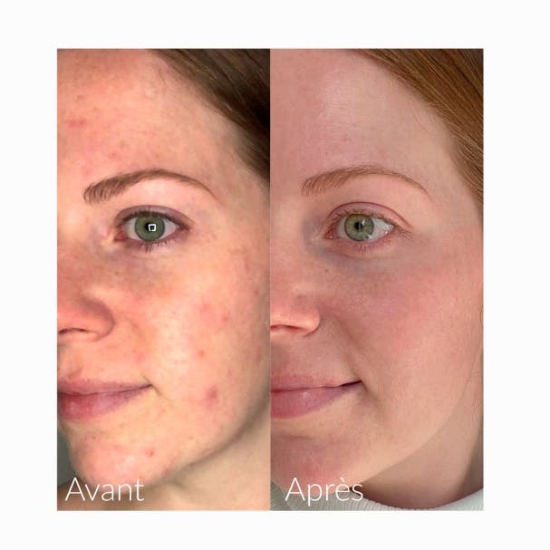 Tinh Chất Làm Mờ Thâm & Thu Nhỏ Lỗ Chân Lông Caudalie Vinopure Serum Salicylique Anti-Imperfections 30ml