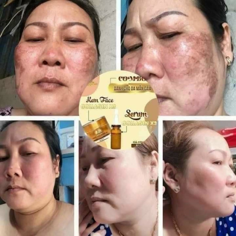 Serum Nám Collagen X3 Đông Anh