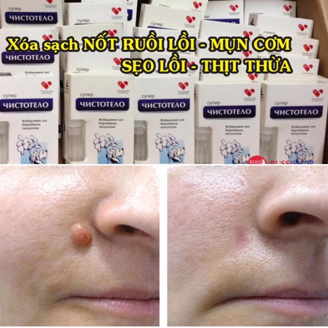Combo Gel Tẩy Nốt Ruồi, Tàn Nhang và Kem Sẹo Mờ Thâm của Nga | BigBuy360 - bigbuy360.vn