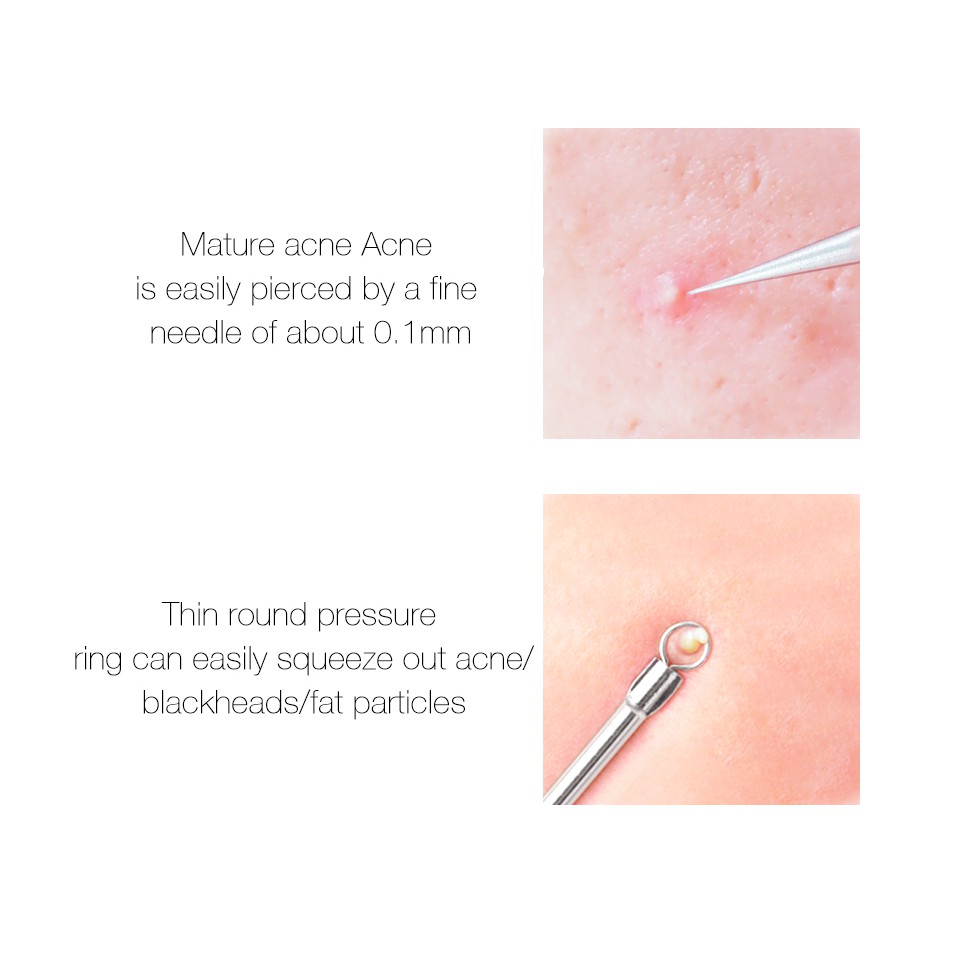 Dụng Cụ Nặn Mụn Đầu Đen O.TWO.O 10g 12.3cm 1 Pcs