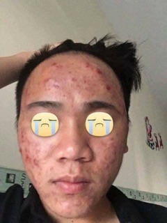 Combo 1: thuốc+ bột rửa mặt + bột mặt nạ