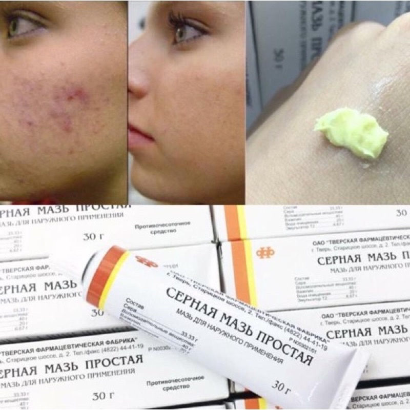 Kem chuyên mụn bọc, trứng cá lưu huỳnh Cephar Nga