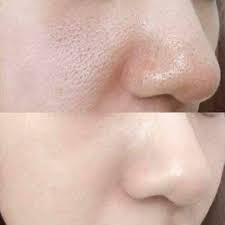 Tế bào gốc POCIA - lỗ chân lông to. Lọ 10ml