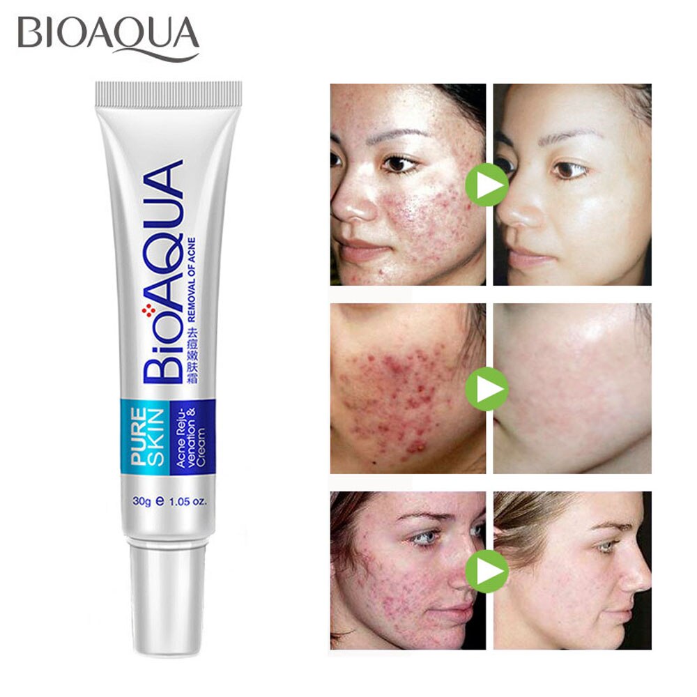 (Hàng Mới Về) Bộ Sản Phẩm Trị Sẹo Mụn Bioaqua Chất Lượng Cao