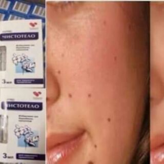 GEO TÂYE NỐT RUỒI ,MỤN CƠM ,MỤN CÓC ,THỊT THỪA