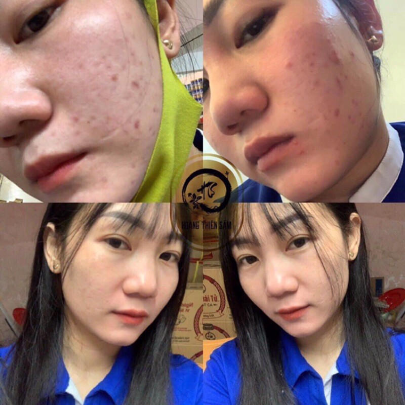 Combo Hoàng Thiên Sâm truyền thống sạch mụn thâm .