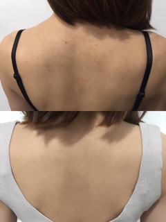 Xịt giảm thâm mụn lưng For Back