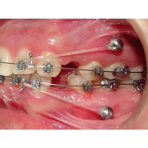 Mini vít dùng trong chỉnh nha,vật liệu chỉnh nha vít titan